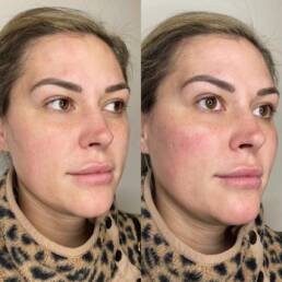 Cheek filler Before & After