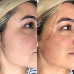 Dermaplane Facial in Parker CO by Beauty Refined