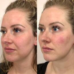 Full facial filler rejuvenation Before & After