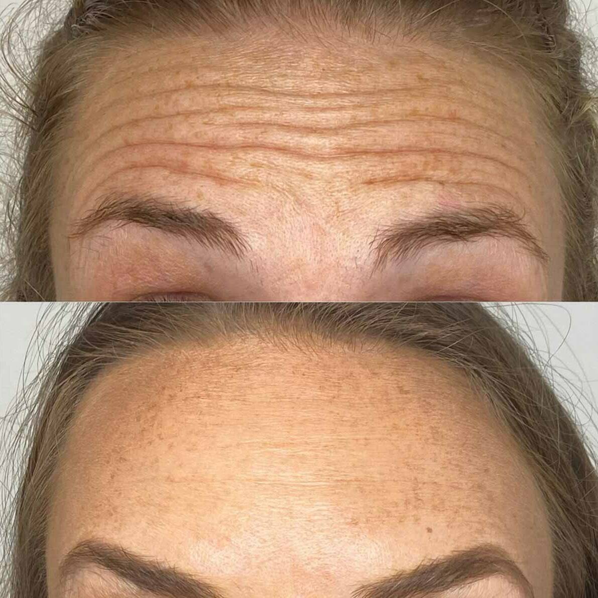 Neurotoxin 3 Forehead Lines | Beauty Refined in Denver Tech Center, & Parker Colorado