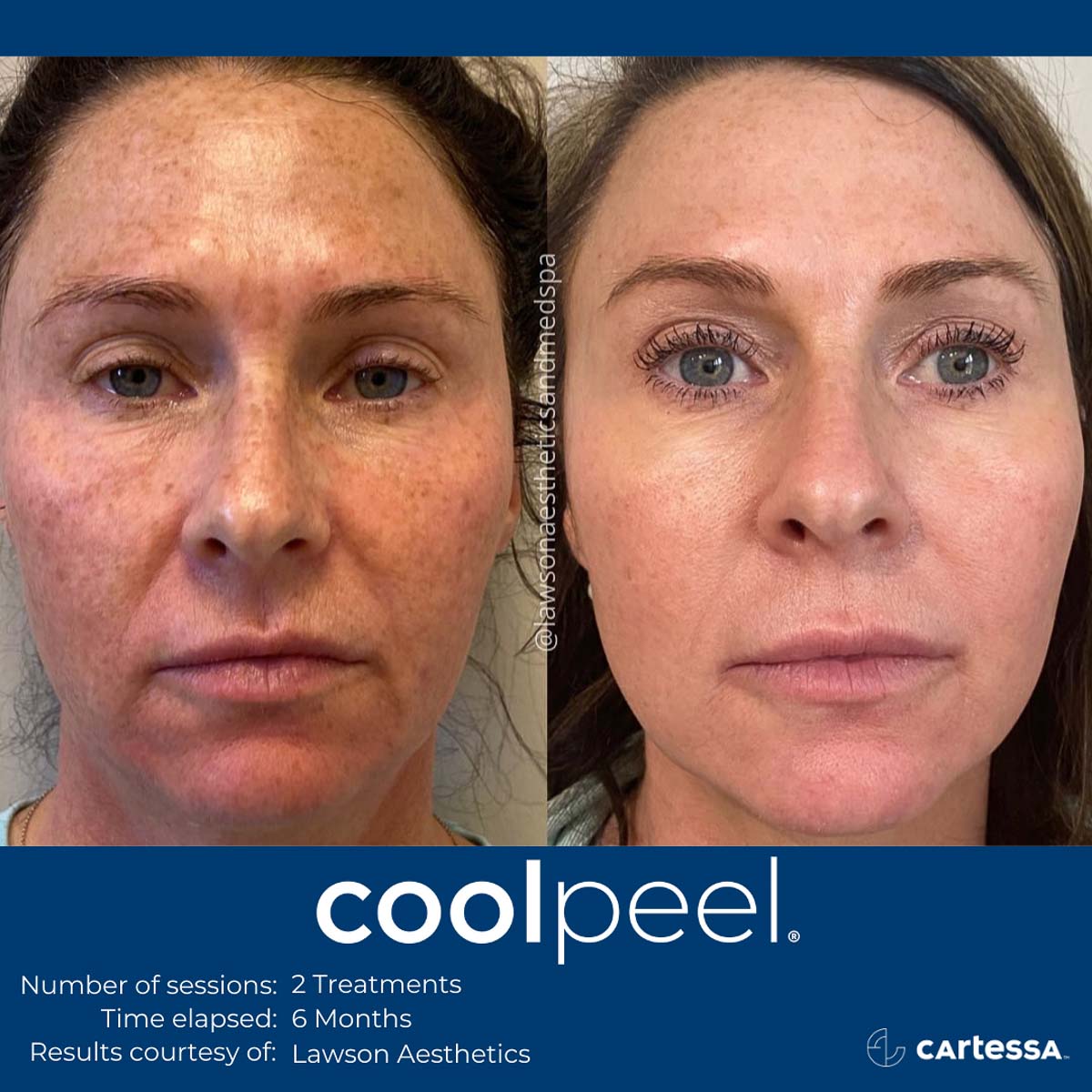 Before and After Cool peel Treatments in Denver Tech Center, & Parker Colorado