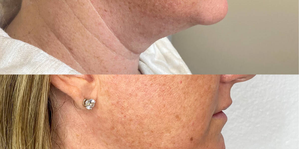 Kybella Injections | Before and After Gallery
