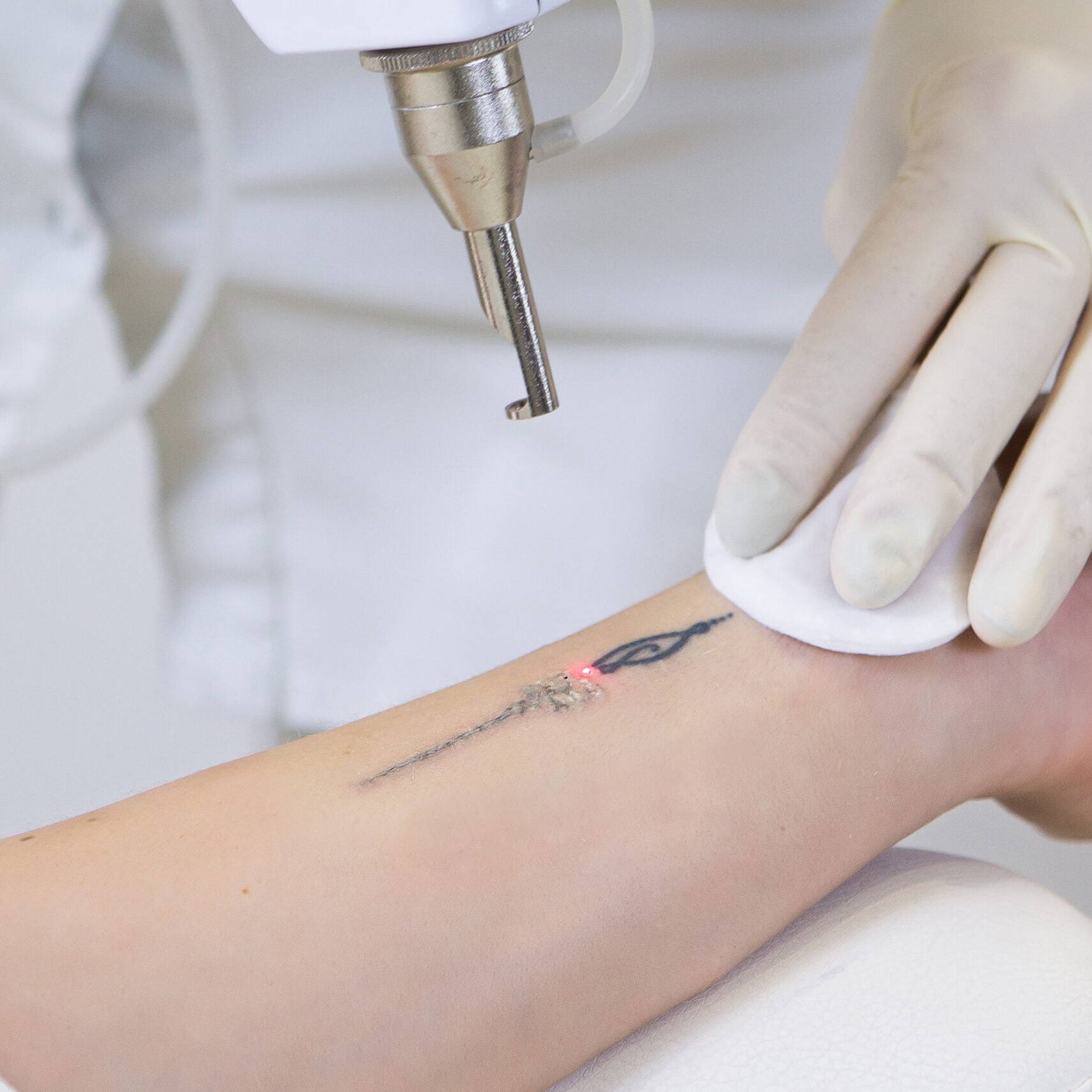 Laser Tattoo Removal by Beauty refined