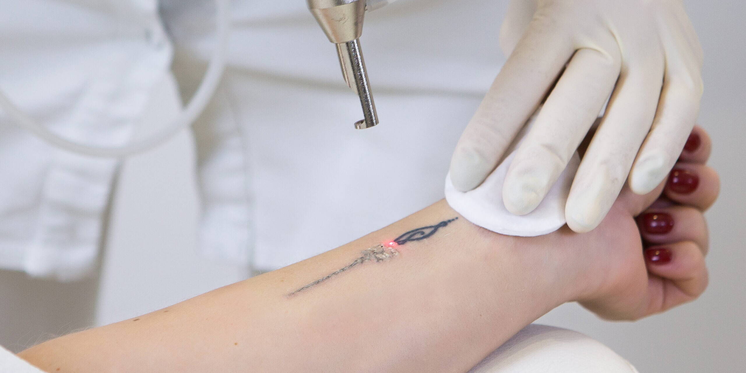 Laser Tattoo Removal by Beauty refined