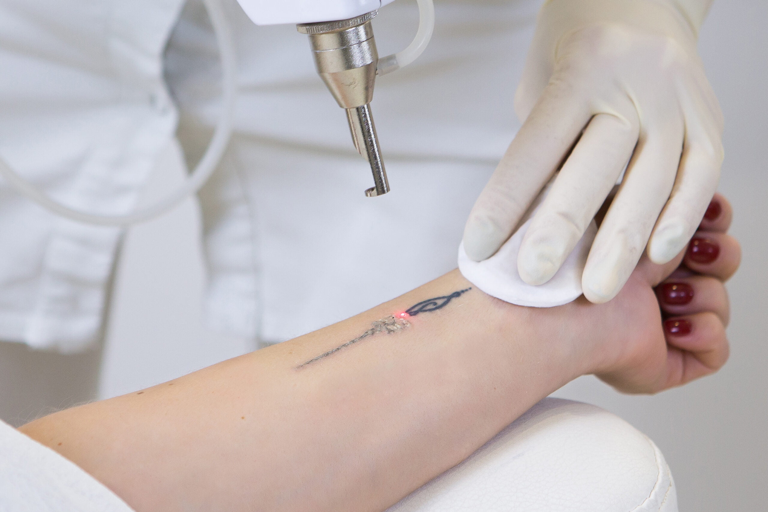 Laser Tattoo Removal by Beauty refined