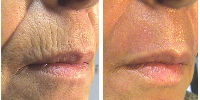 CO2 Laser Treatment