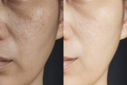 Refined Glow Laser Treatment