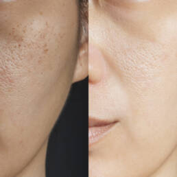 Refined Glow Laser Treatment