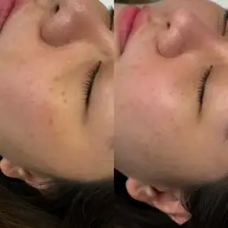 Laser Treatments in Parker CO by Beauty Refined