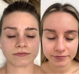 Facial Treatment in Parker CO by Beauty Refined