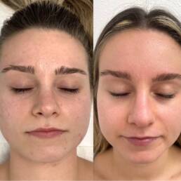 Facial Treatment in Parker CO by Beauty Refined